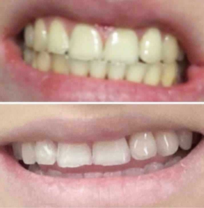 Metamorfoza uśmiechu po zabiegach higienizacja Elbląg