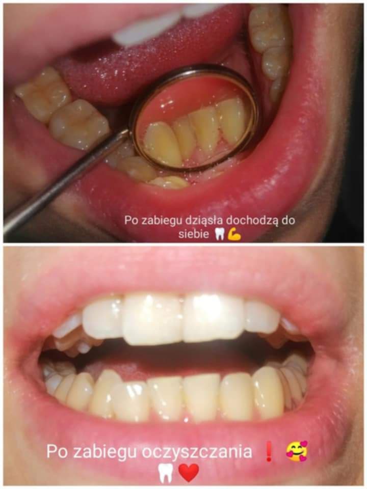 Efekt pracy higienistki AurisDent w ramach higienizacja Elbląg