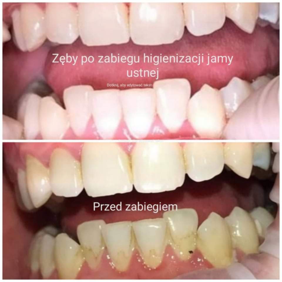 Rozświetlony uśmiech po serii zabiegów higienizacja Elbląg