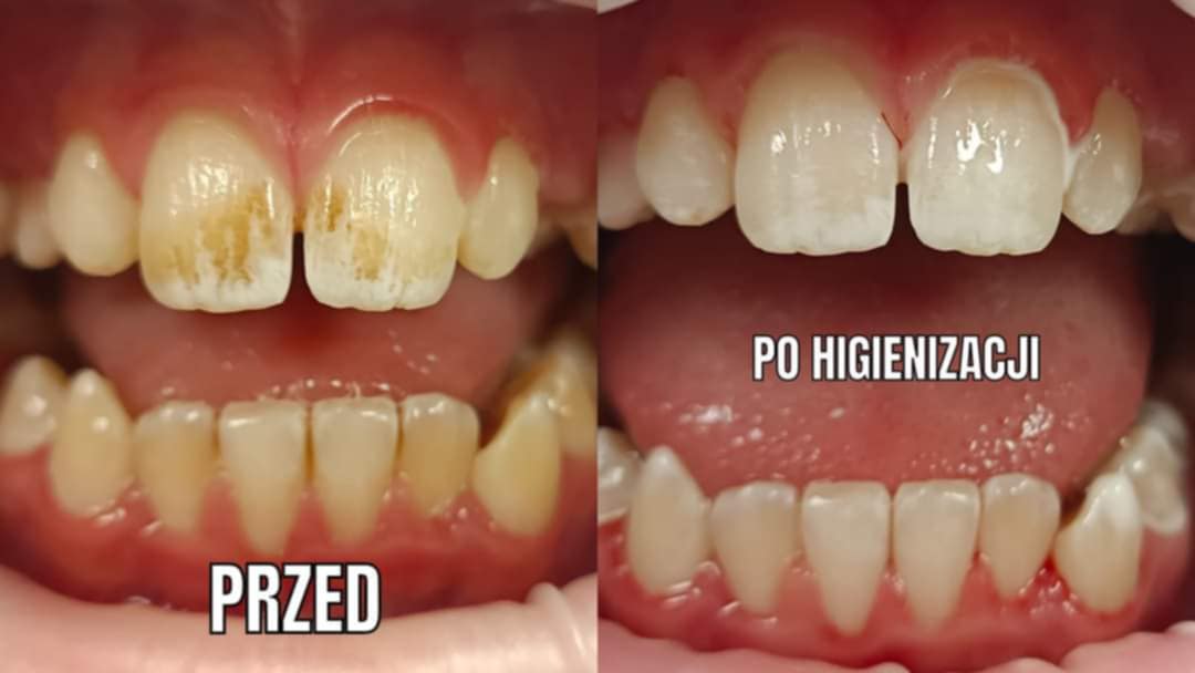 Przemiana estetyki zębów po zabiegach higienizacja Elbląg