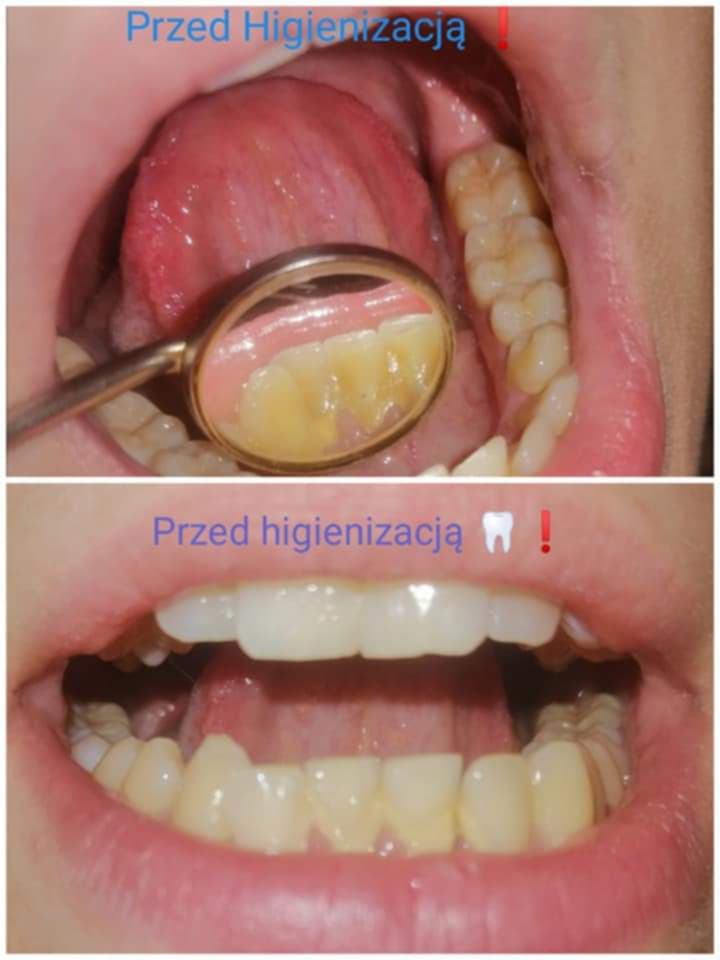 Rezultat kompleksowej higienizacja Elbląg w AurisDent