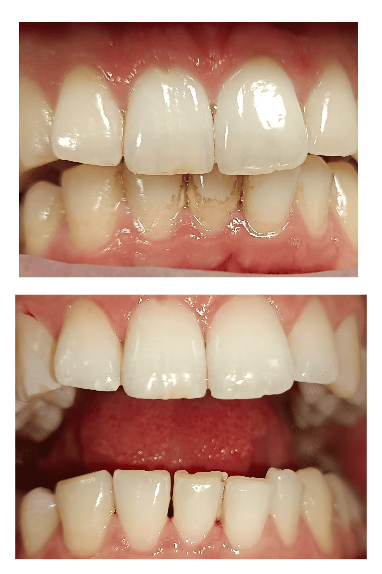 Metamorfoza uśmiechu Damiana po zabiegach AurisDent higienizacja Elbląg