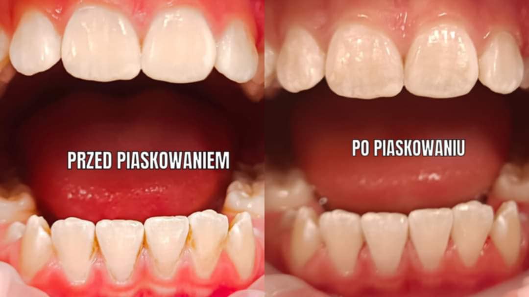 Kolejna metamorfoza uśmiechu dzięki zabiegom AurisDent higienizacja Elbląg
