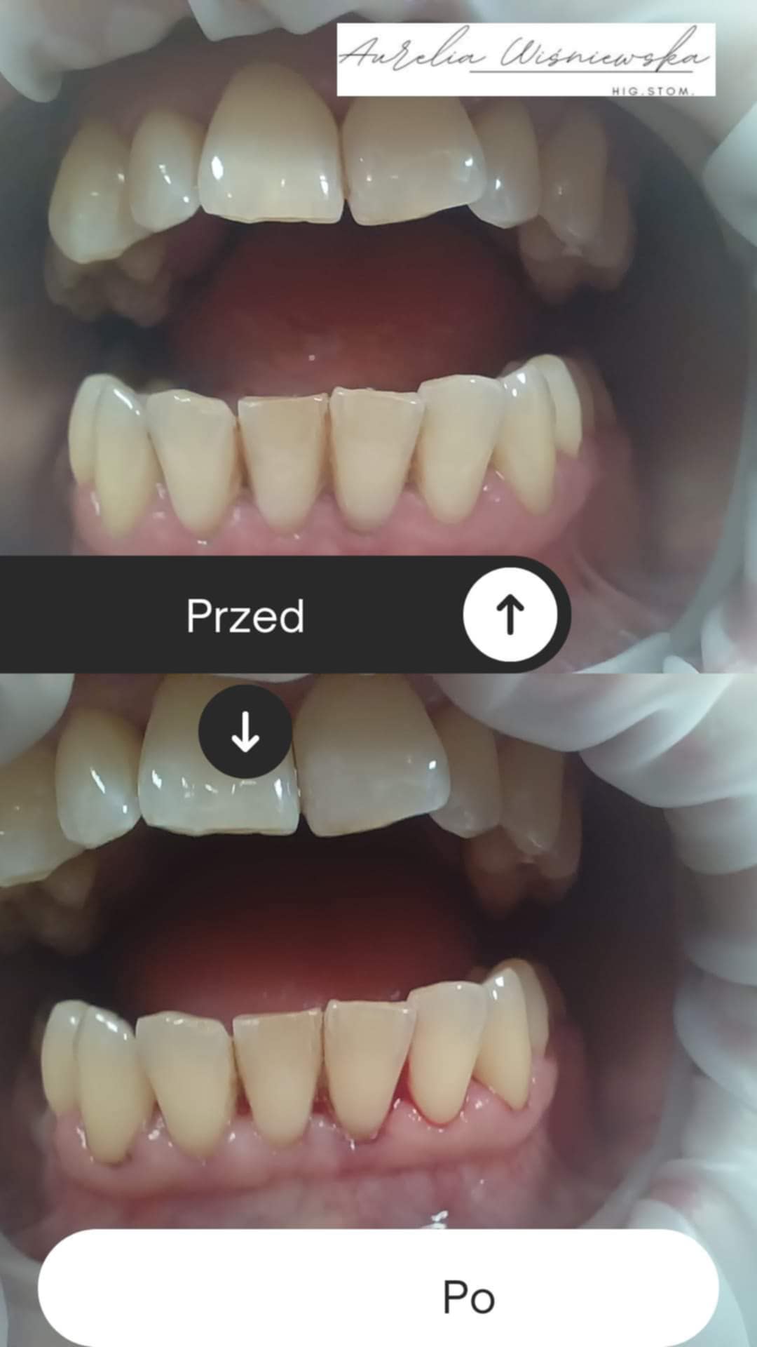 Przemiana uśmiechu po zabiegach higienizacja Elbląg – etap czwarty