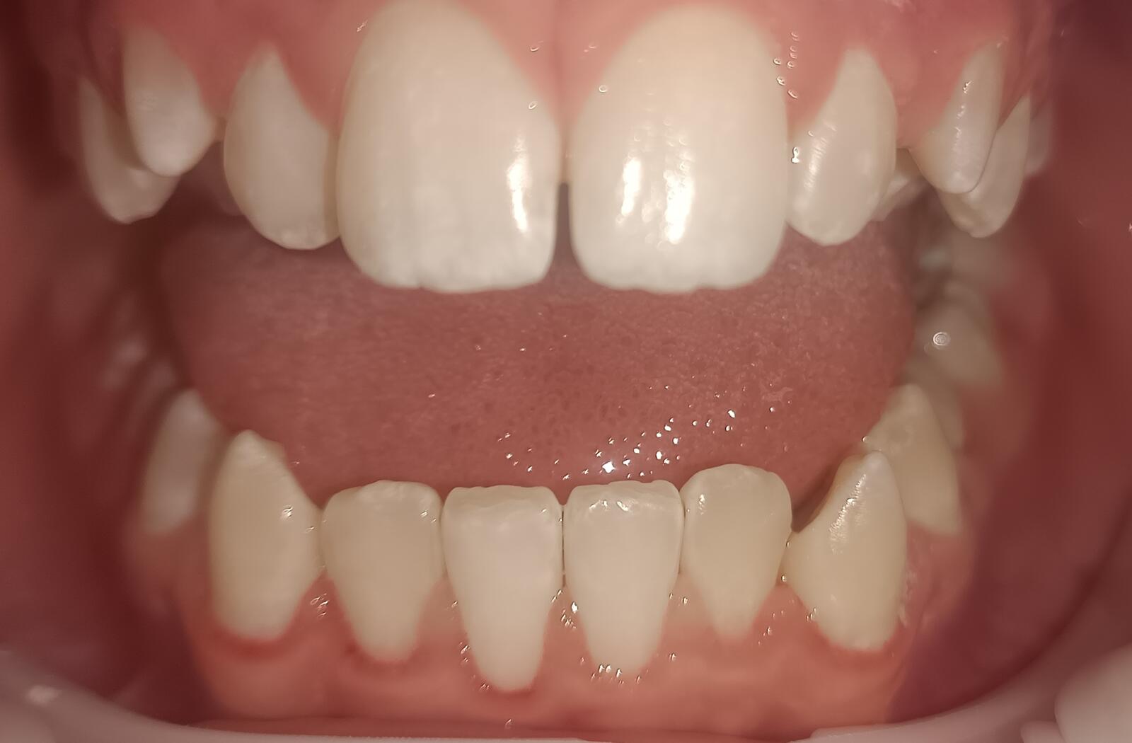 Efekt wybielania nakładkowego po zabiegach higienizacja Elbląg w AurisDent